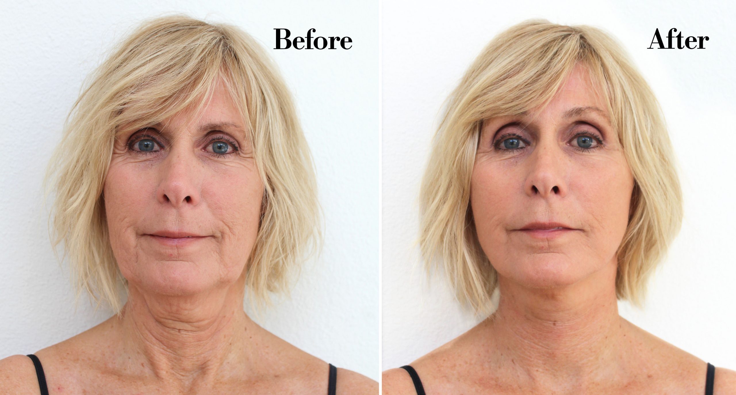 Non Surgical Face Lifts Thermage Vs Titan